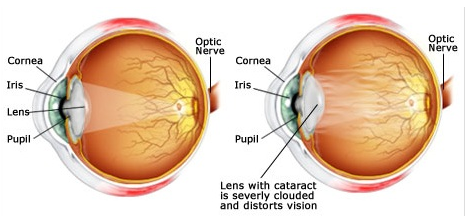 Cataract - Dr. Sagar Bhargava
